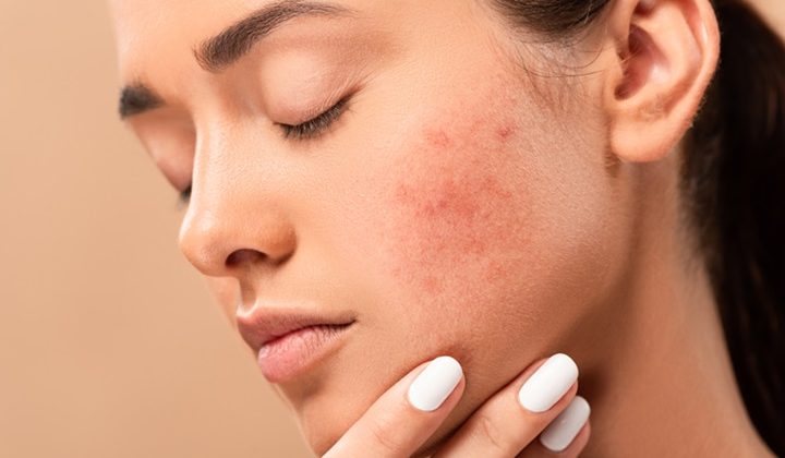 Acne Positivity Day: Η ακμή δεν επηρεάζει μόνο το δέρμα μας 